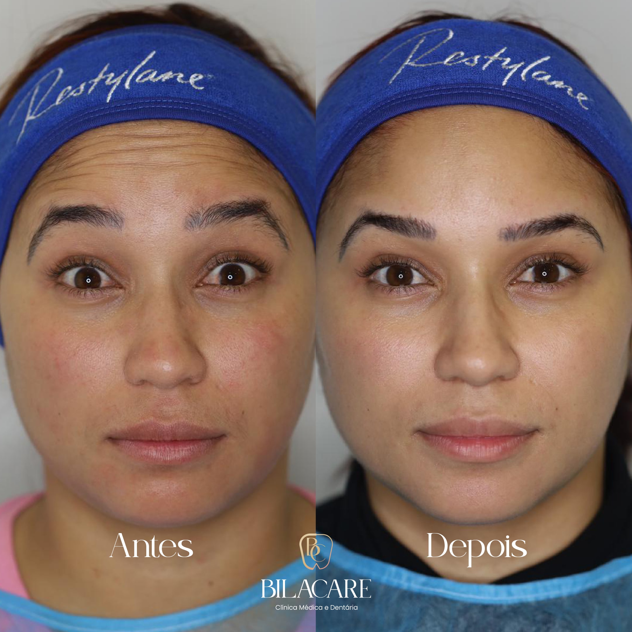 Botox - Antes e Depois