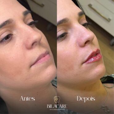 Preenchimento Labial - Antes e Depois
