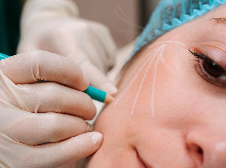 Bioestimuladores de colagénio - Bilacare