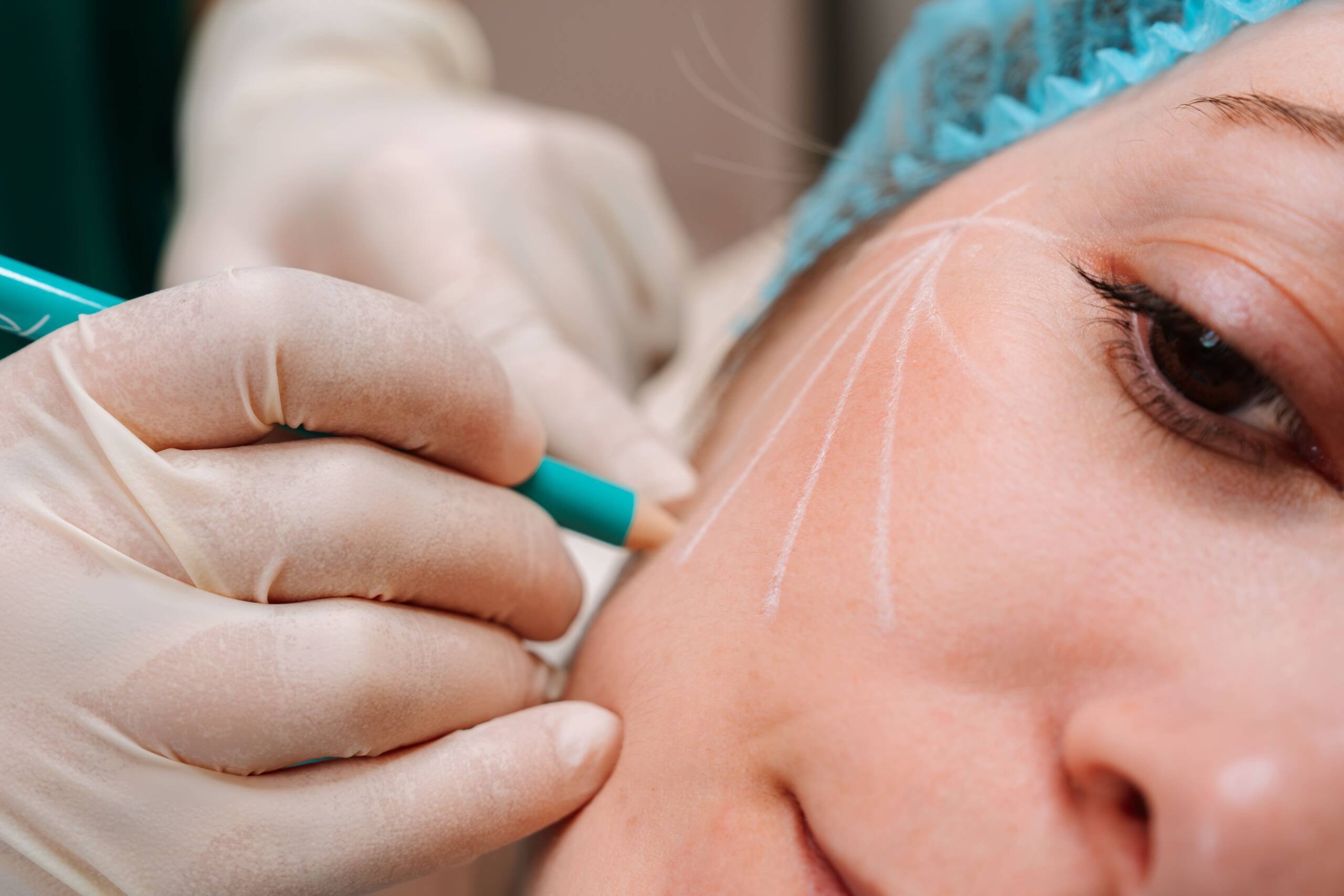 Bioestimuladores de colagénio - Bilacare